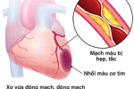 Đau thắt ngực và thiếu máu cơ tim