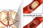 Phòng ngừa tai biến mạch não khi trời lạnh 