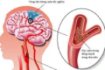 Bệnh xơ vữa động mạch não