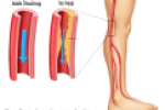 Bệnh động mạch chi dưới ở người cao tuổi dễ nặng lên vào mùa lạnh